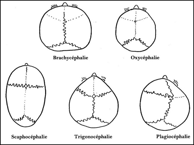 Maladies Rares En Pediatrie