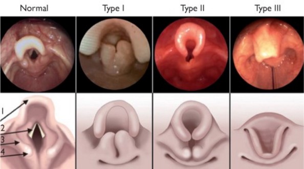 Maladies Rares En Pediatrie