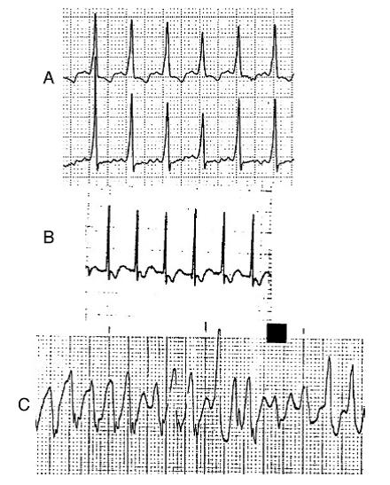 Cureus  Barrett's Esophagus in Rubinstein-Taybi Syndrome